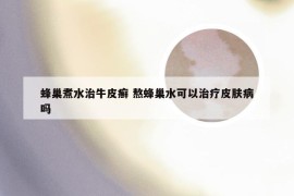 蜂巢煮水治牛皮癣 熬蜂巢水可以治疗皮肤病吗