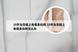 19岁女生腿上有很多白斑 19岁女生腿上有很多白斑怎么办