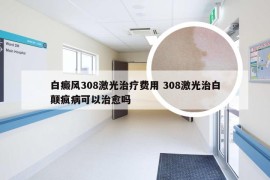 白癜风308激光治疗费用 308激光治白颠疯病可以治愈吗