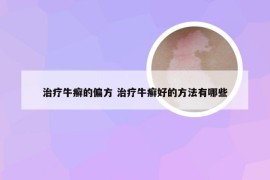 治疗牛癣的偏方 治疗牛癣好的方法有哪些