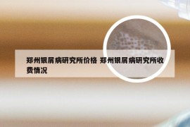 郑州银屑病研究所价格 郑州银屑病研究所收费情况