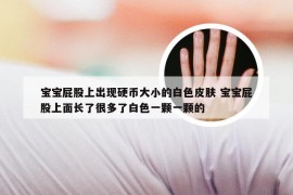 宝宝屁股上出现硬币大小的白色皮肤 宝宝屁股上面长了很多了白色一颗一颗的
