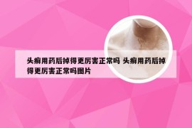 头癣用药后掉得更厉害正常吗 头癣用药后掉得更厉害正常吗图片