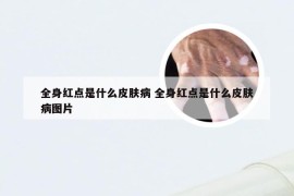 全身红点是什么皮肤病 全身红点是什么皮肤病图片