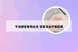 牛皮癣苦参熬水洗 苦参汤治疗银屑病