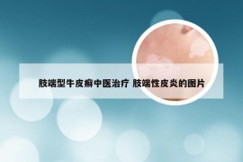 肢端型牛皮癣中医治疗 肢端性皮炎的图片