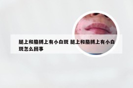 腿上和胳膊上有小白斑 腿上和胳膊上有小白斑怎么回事