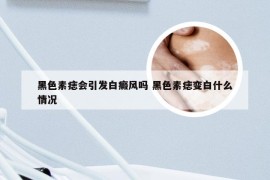 黑色素痣会引发白癜风吗 黑色素痣变白什么情况