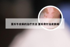 董氏牛皮癣的治疗方法 董氏奇针治皮肤病