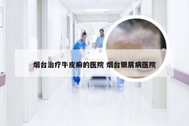 烟台治疗牛皮癣的医院 烟台银屑病医院