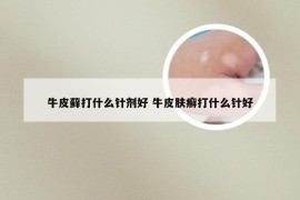 牛皮藓打什么针剂好 牛皮肤癣打什么针好