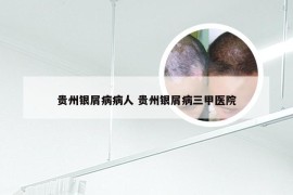 贵州银屑病病人 贵州银屑病三甲医院