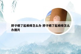 脖子晒了起癣痒怎么办 脖子晒了起癣痒怎么办图片