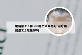 银屑病311和308哪个效果更好 治疗银屑病311效果好吗