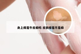 身上痒是牛皮癣吗 皮肤痒是不是癣