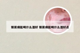 银屑病能喝什么酒好 银屑病能喝什么酒好点