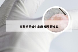 哪些明星长牛皮癣 明星得皮炎