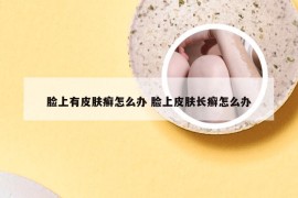 脸上有皮肤癣怎么办 脸上皮肤长癣怎么办