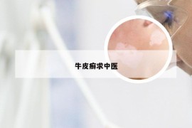 牛皮癣求中医