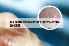 蚊子叮的红点和银屑病 蚊子叮的小红点和红包的区别