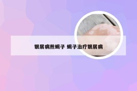 银屑病煎蝎子 蝎子治疗银屑病