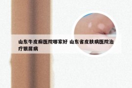 山东牛皮癣医院哪家好 山东省皮肤病医院治疗银屑病