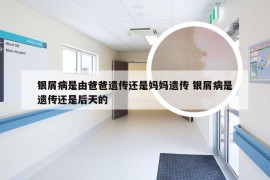 银屑病是由爸爸遗传还是妈妈遗传 银屑病是遗传还是后天的