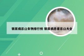 银屑病忌口食物排行榜 银屑病患者忌口大全