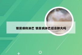 银屑病和淋巴 银屑病淋巴结会肿大吗