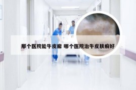 那个医院能牛皮廨 哪个医院治牛皮肤癣好