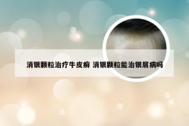 消银颗粒治疗牛皮癣 消银颗粒能治银屑病吗