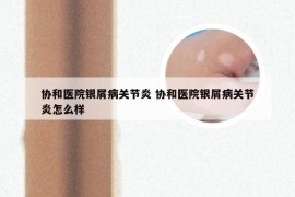 协和医院银屑病关节炎 协和医院银屑病关节炎怎么样