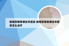 脓疱型银屑病合并感染 脓疱型银屑病合并感染怎么治疗