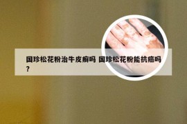 国珍松花粉治牛皮癣吗 国珍松花粉能抗癌吗?