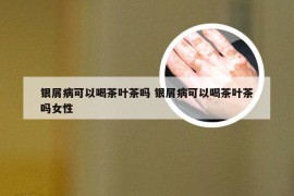 银屑病可以喝茶叶茶吗 银屑病可以喝茶叶茶吗女性