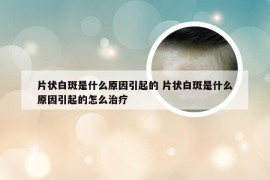 片状白斑是什么原因引起的 片状白斑是什么原因引起的怎么治疗