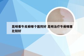 昆明看牛皮癣哪个医院好 昆明治疗牛癣哪里比较好