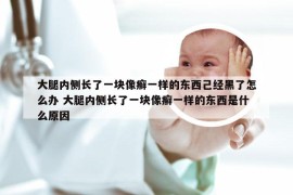 大腿内侧长了一块像癣一样的东西己经黑了怎么办 大腿内侧长了一块像癣一样的东西是什么原因