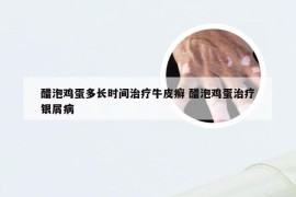 醋泡鸡蛋多长时间治疗牛皮癣 醋泡鸡蛋治疗银屑病