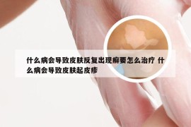 什么病会导致皮肤反复出现癣要怎么治疗 什么病会导致皮肤起皮疹