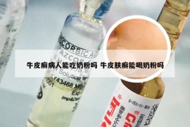 牛皮癣病人能吃奶粉吗 牛皮肤癣能喝奶粉吗