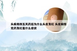 头癣用四五天药后为什么头皮发红 头皮癣擦完药发红是什么症状