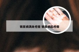银屑病满身疙瘩 银屑病起疙瘩