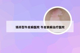 钱币型牛皮癣医院 牛皮肤癣治疗医院