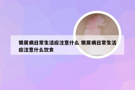 银屑病日常生活应注意什么 银屑病日常生活应注意什么饮食