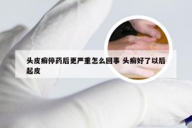 头皮癣停药后更严重怎么回事 头癣好了以后起皮