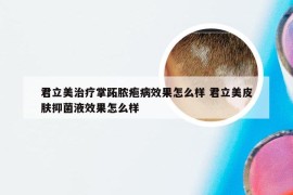 君立美治疗掌跖脓疱病效果怎么样 君立美皮肤抑菌液效果怎么样