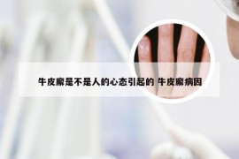 牛皮廨是不是人的心态引起的 牛皮廨病因