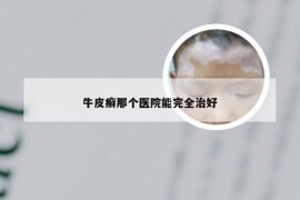 牛皮癣那个医院能完全治好