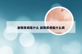 副银屑病是什么 副银屑病是什么病